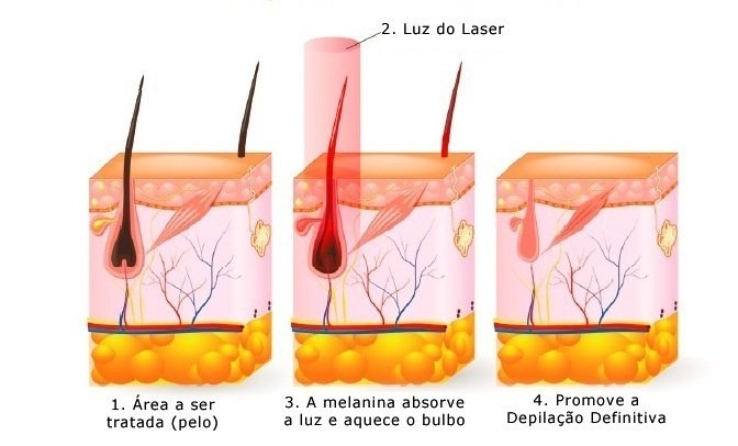 Depilação a laser é definitiva?