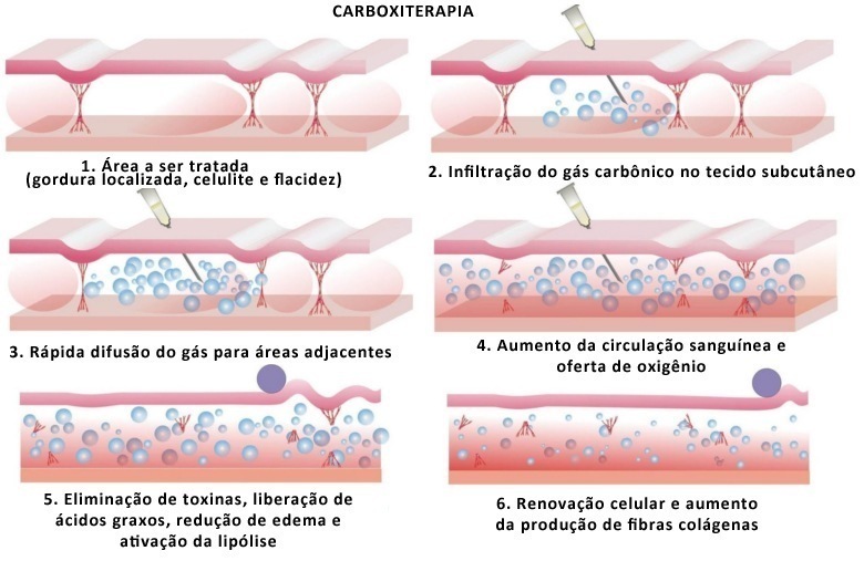 carboxiterapia-efeito-Fisest
