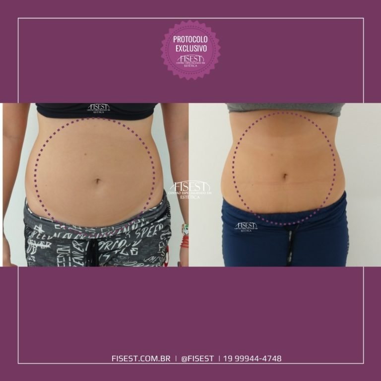 Lipo Hd Não Aspirativa Fisest Estéticafisest Estética 7091