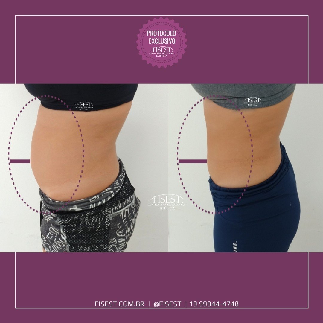 Lipo HD Não Aspirativa - Fisest EstéticaFisest Estética