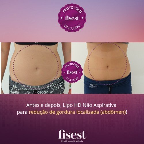 Lipo HD Não Aspirativa - Fisest EstéticaFisest Estética